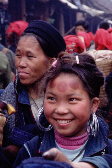 Medical Treatment With Balls On Forehead / Vietnam - Click Image to Close